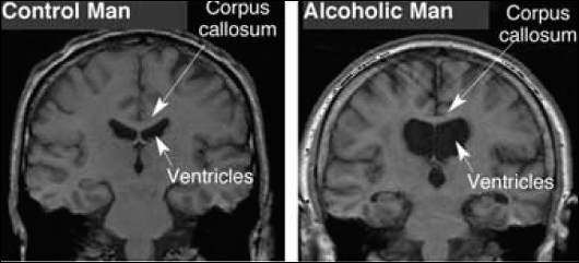 알코올 의존증 환자와 건강한 사람의 뇌 촬영 사진. 오른쪽 환자의 뇌는 일반인보다 뇌가 위축된 것을 볼 수 있다.
